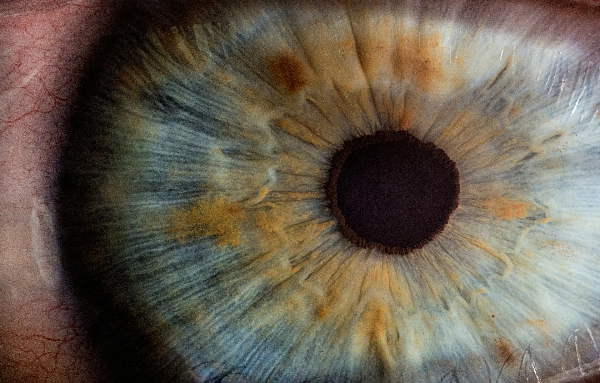 Рак очей регресує у 35% випадків: виявлено новий метод лікування рідкісного раку
