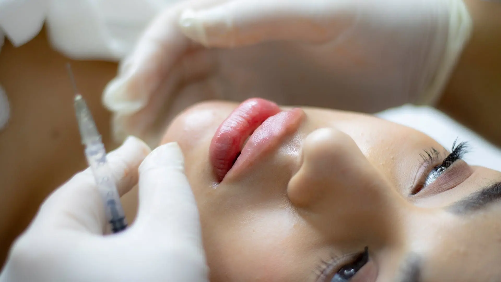 Гіалуронові вуса: Що спричиняє цей небажаний ефект після проведення процедури для збільшення губ
