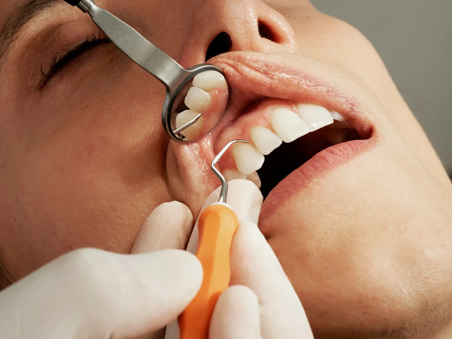 Карієс і інсульт: наслідки захворювання зубів, які можуть призвести до смерті