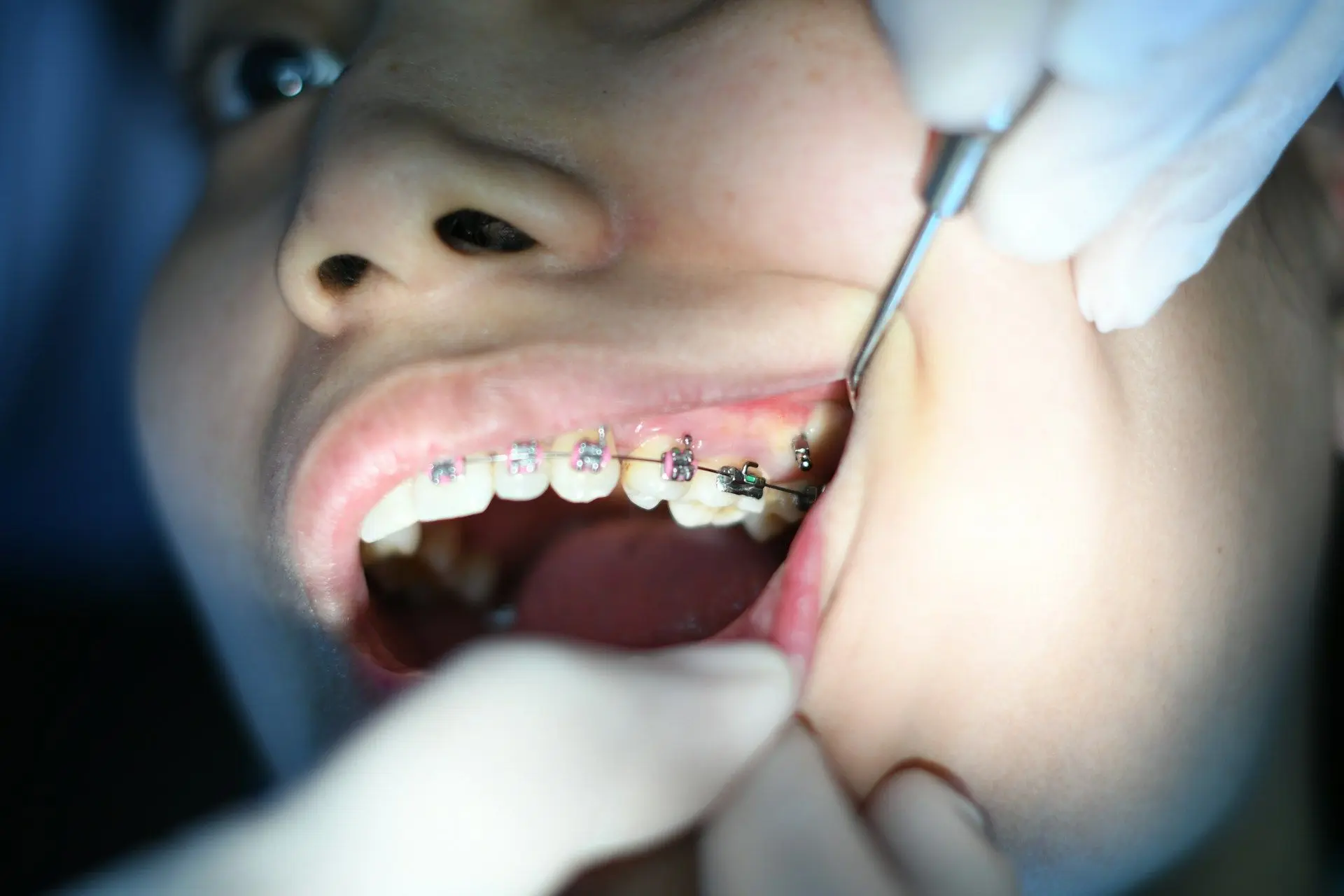 Чому зуби зростають неправильно та як цьому запобігти